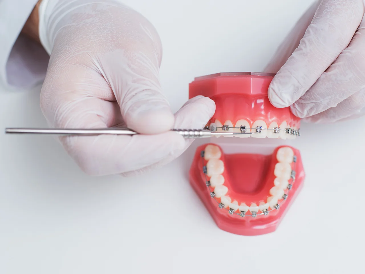 Traditional braces