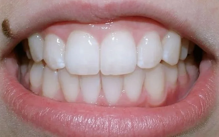 Julia after orthodontic treatment