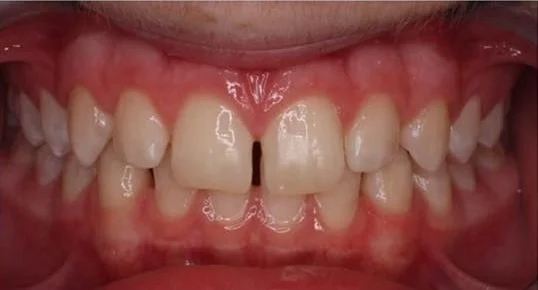 Calvin before orthodontic treatment