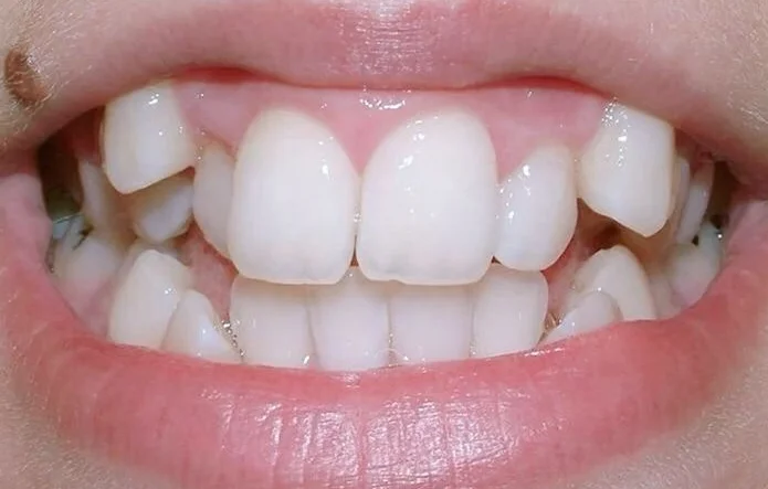 Julia before orthodontic treatment