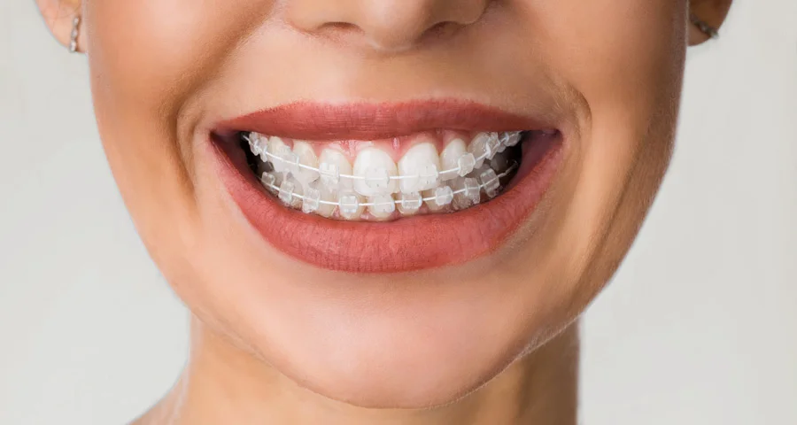 Close-up of clear ceramic brackets