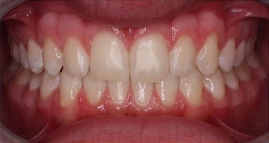 Calvin after orthodontic treatment