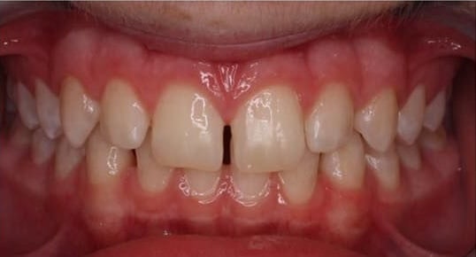 Calvin before orthodontic treatment