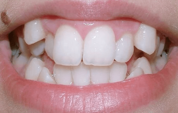 Julia before orthodontic treatment