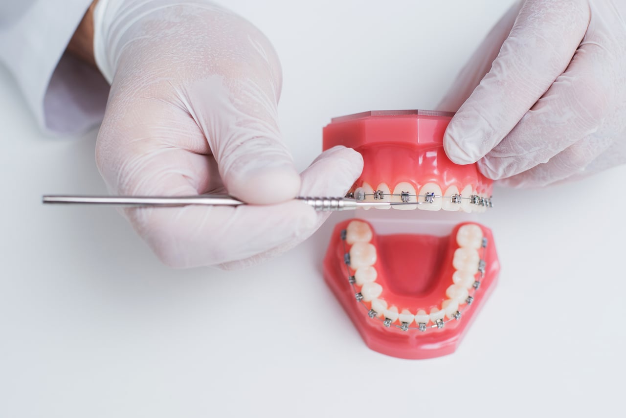 Traditional braces