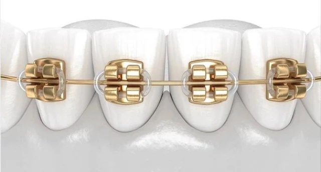 Clear & gold braces