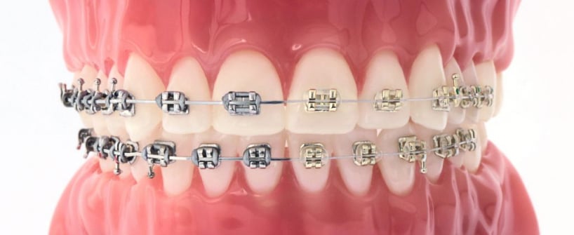 Bracket comparison